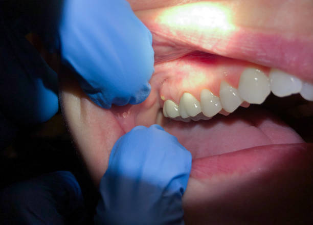 Best Chipped Tooth Repair Near Me  in Post Falls, ID